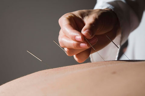 acupuncture patient needles back