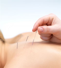 acupuncture on back