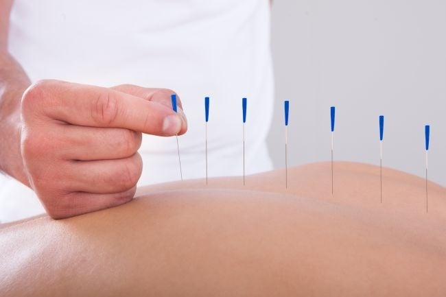 acupuncturist placing needles on a back