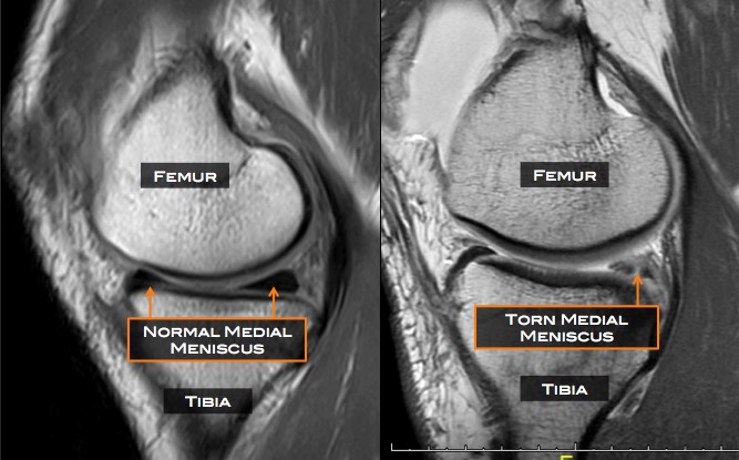 meniscus